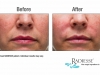 Before / After using Radiesse